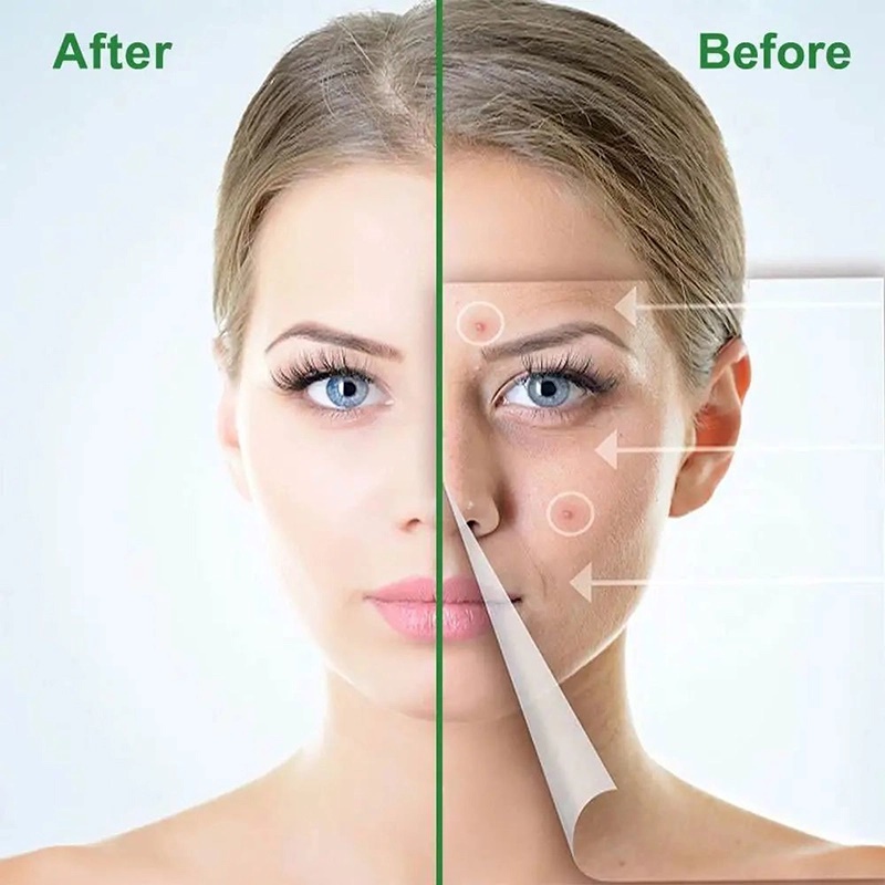 dissolvable microneedle acne patch main image